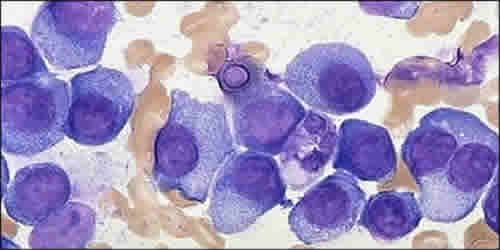 Plasmazellvermehrung im Knochenmark beim multiplen Myelom